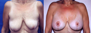 More before and after breast lift photos