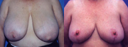 More before and after breast asymmetry photos