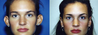 Beverly Hills Otoplasty before and after photos