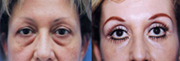 Laser eyelid surgery before and after photos