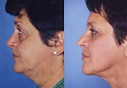 More before and after a Beverly Hills facelift