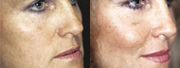 Beverly Hills Facial Implant before and after photos
