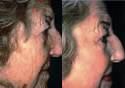 Laser skin resurfacing before and after photos