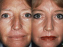 Additional Laser skin resurfacing photos